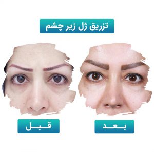 تزریق ژل زیر چشم