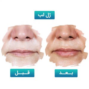 تزریق ژل لب