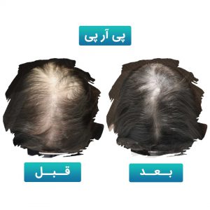 پی آر پی مو