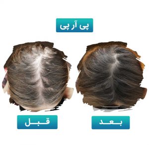پی آر پی مو