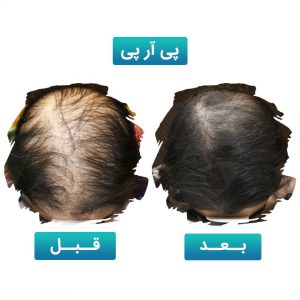پی آر پی مو