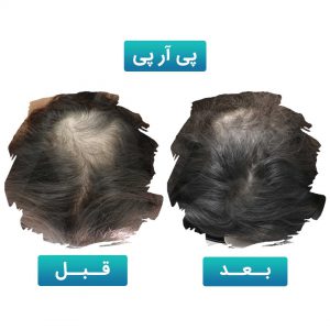پی آر پی مو