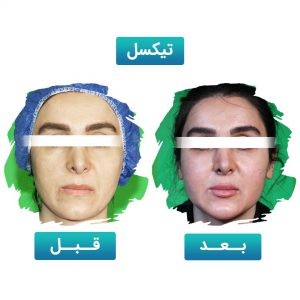 تیکسل