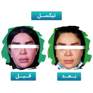 تیکسل