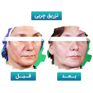 تزریق چربی