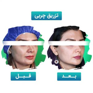 تزریق چربی