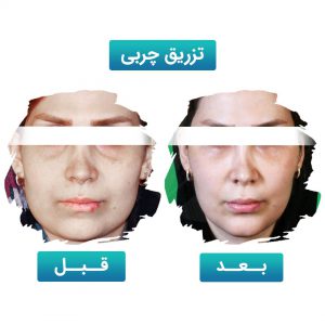 تزریق چربی
