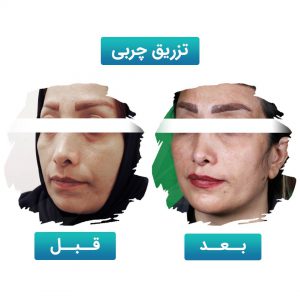 تزریق چربی
