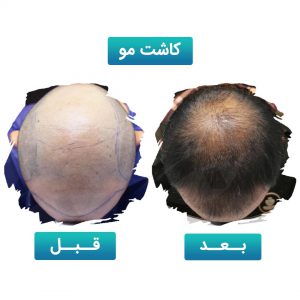 کاشت مو