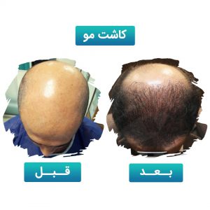 کاشت مو