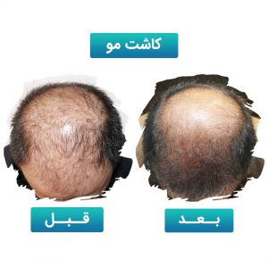 کاشت مو