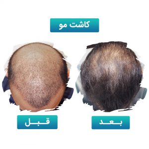 کاشت مو