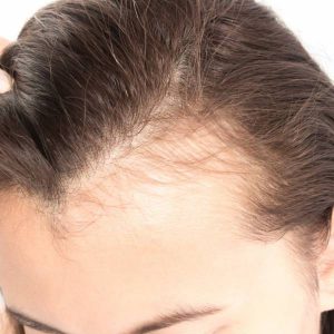 تلوژن افوولین