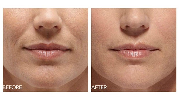 ویژگی های ساختاری ژل درموفیل