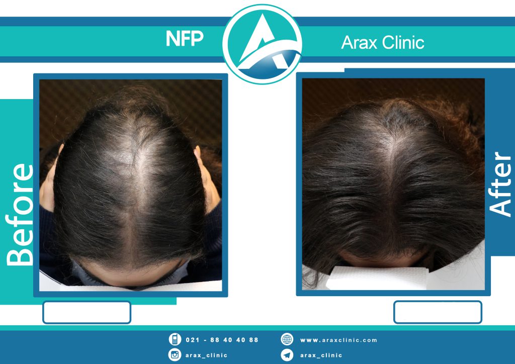 نمونه درمان ریزش مو به روش NFP