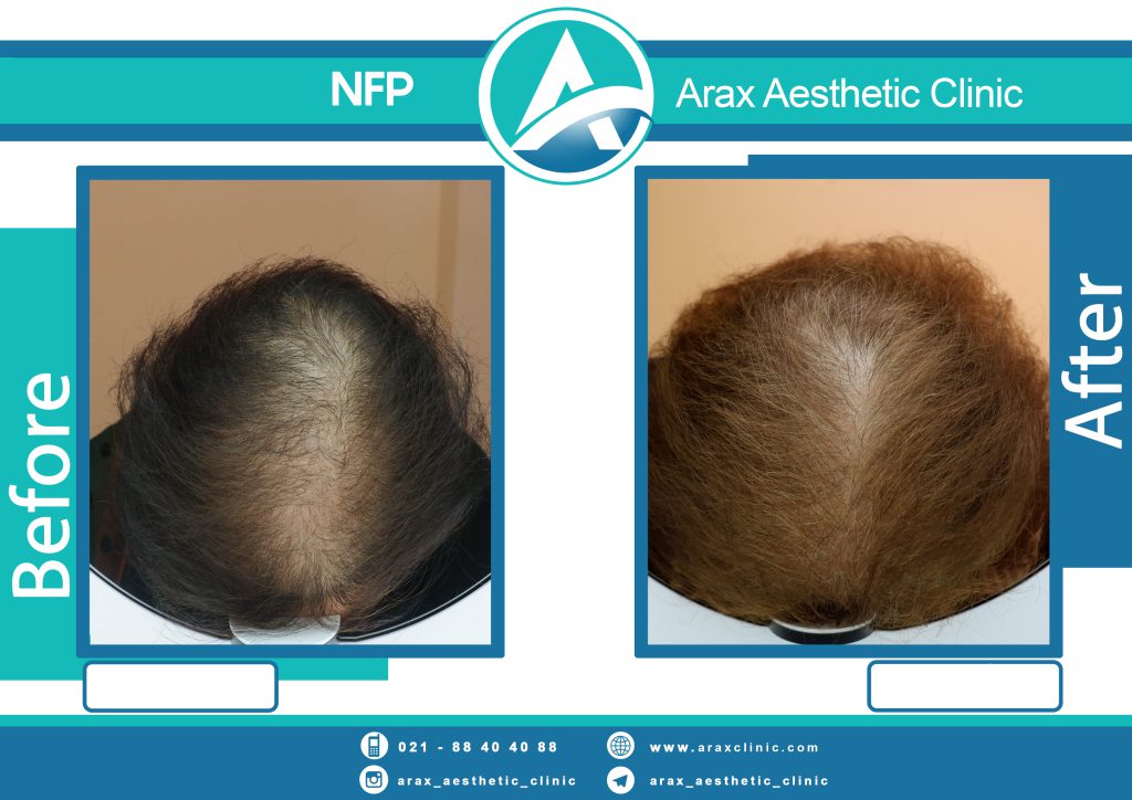 نمونه درمان ریزش مو به روش NFP