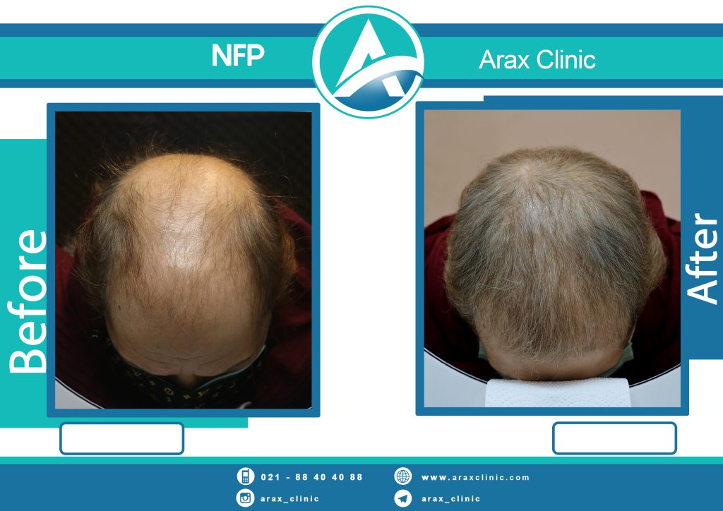 نمونه درمان ریزش مو به روش NFP