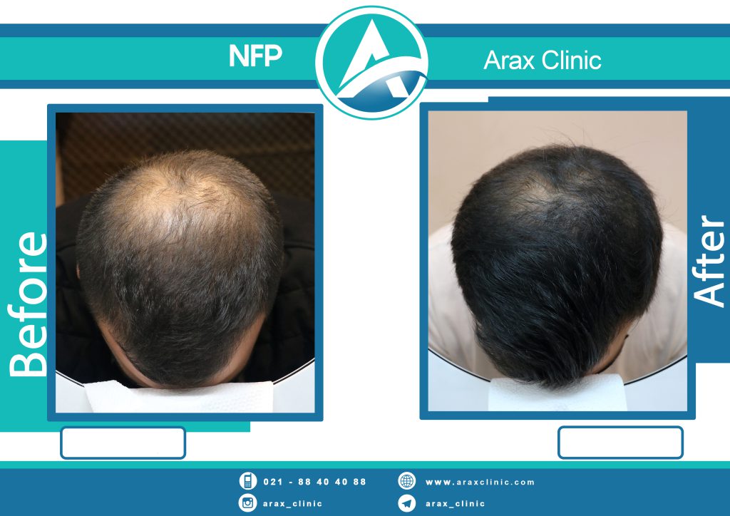 نمونه درمان ریزش مو به روش NFP