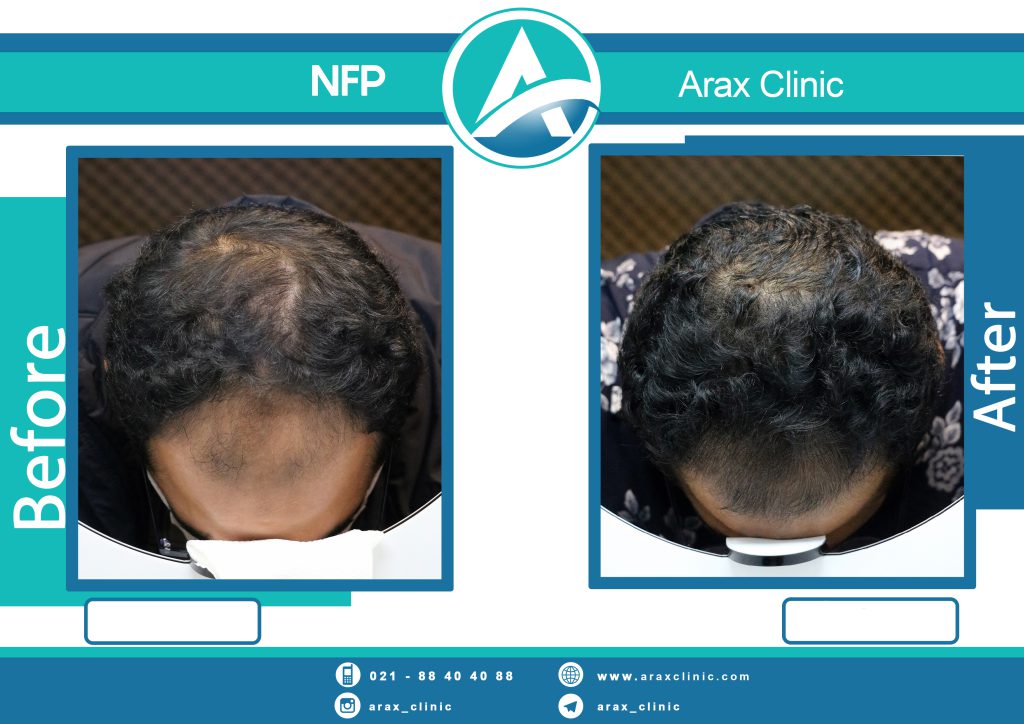 نمونه درمان ریزش مو به روش NFP