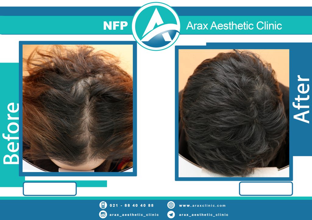 نمونه درمان ریزش مو به روش NFP