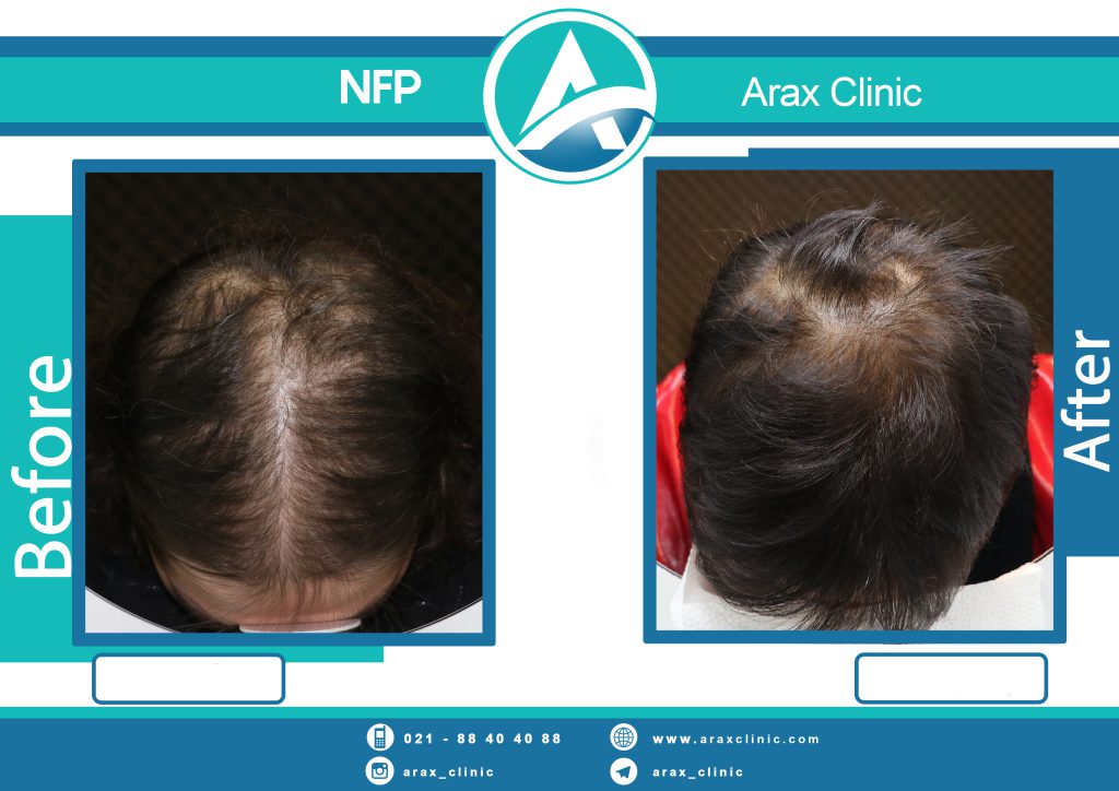 نمونه درمان ریزش مو به روش NFP
