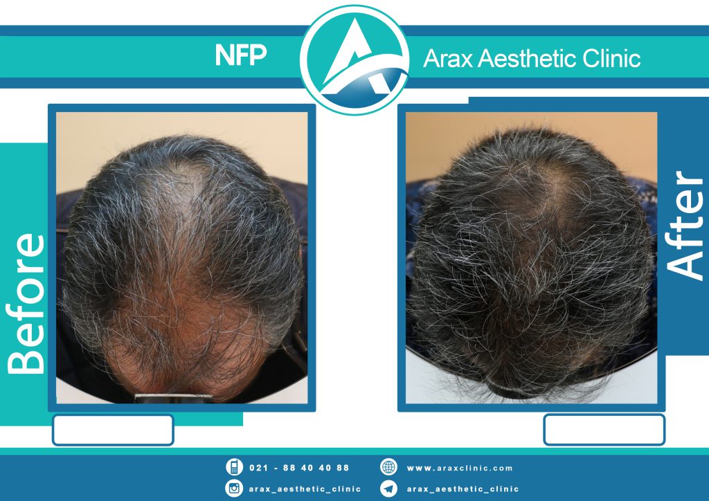 نمونه درمان ریزش مو به روش NFP