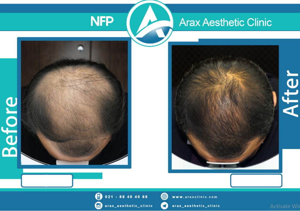 نمونه درمان ریزش مو به روش NFP