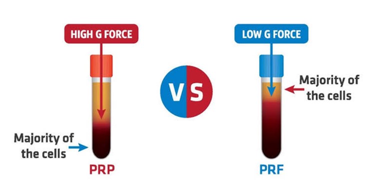 تفاوت prf و prp