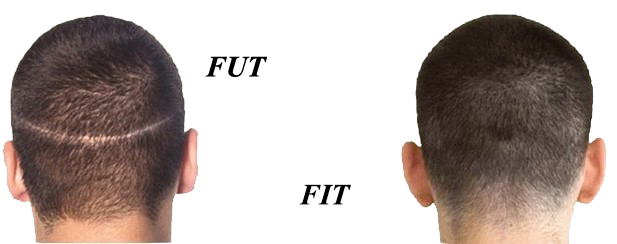 مقایسه دو روش کاشت FUT و FIT